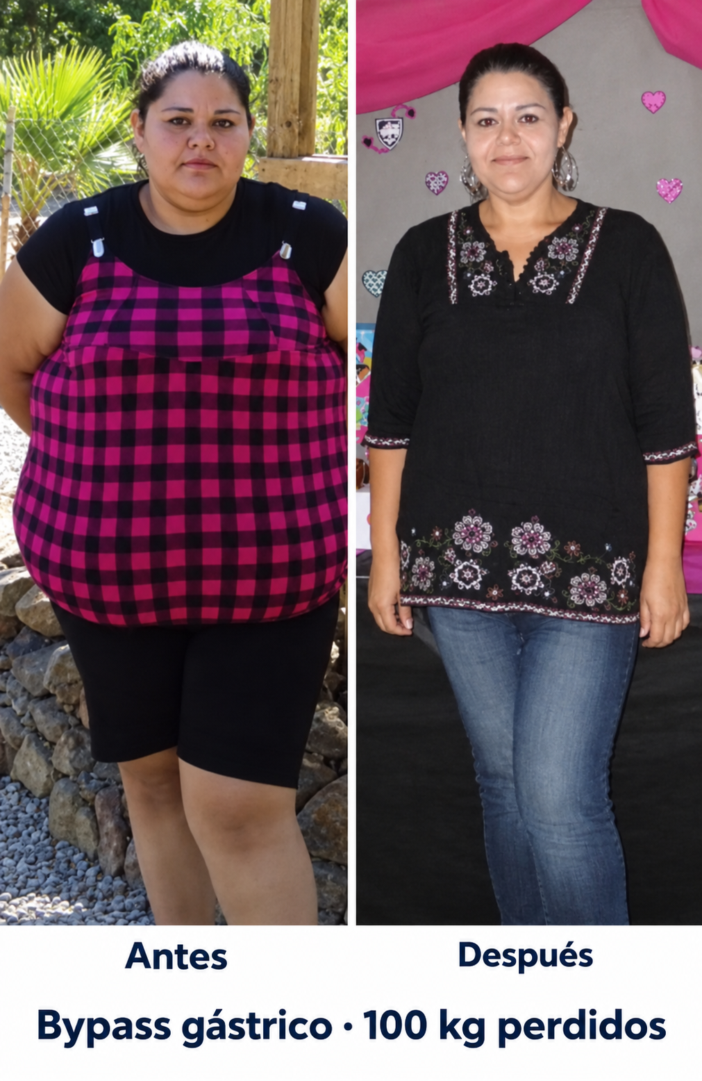 Antes y después de una paciente con bypass gástrico y 100 kg perdidos