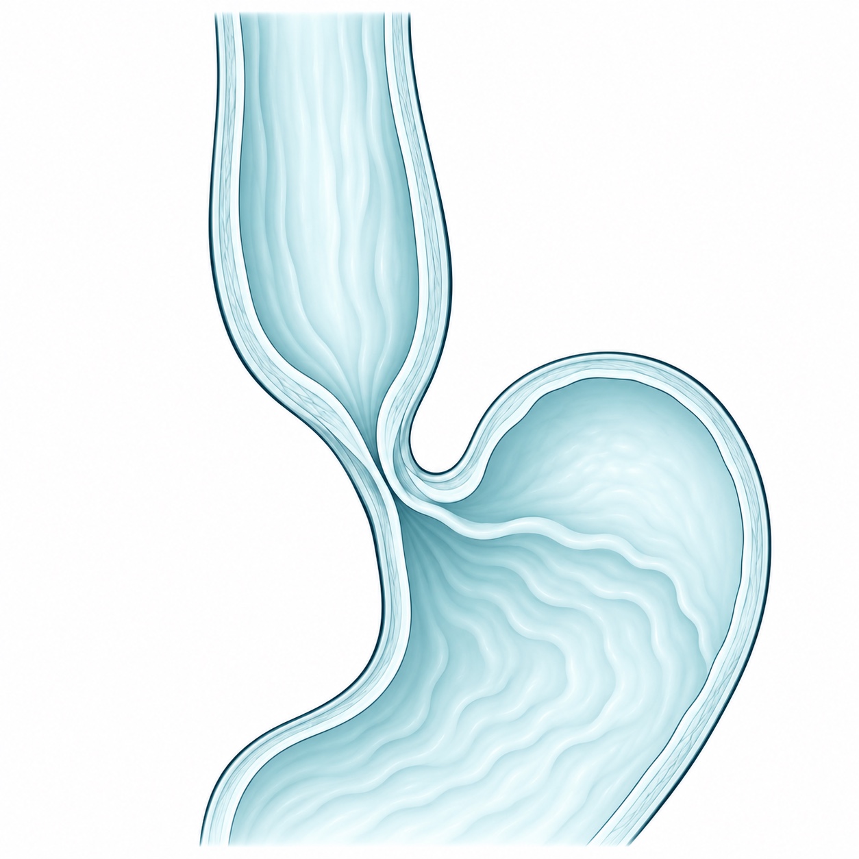 Esquema ilustrativo de acalasia