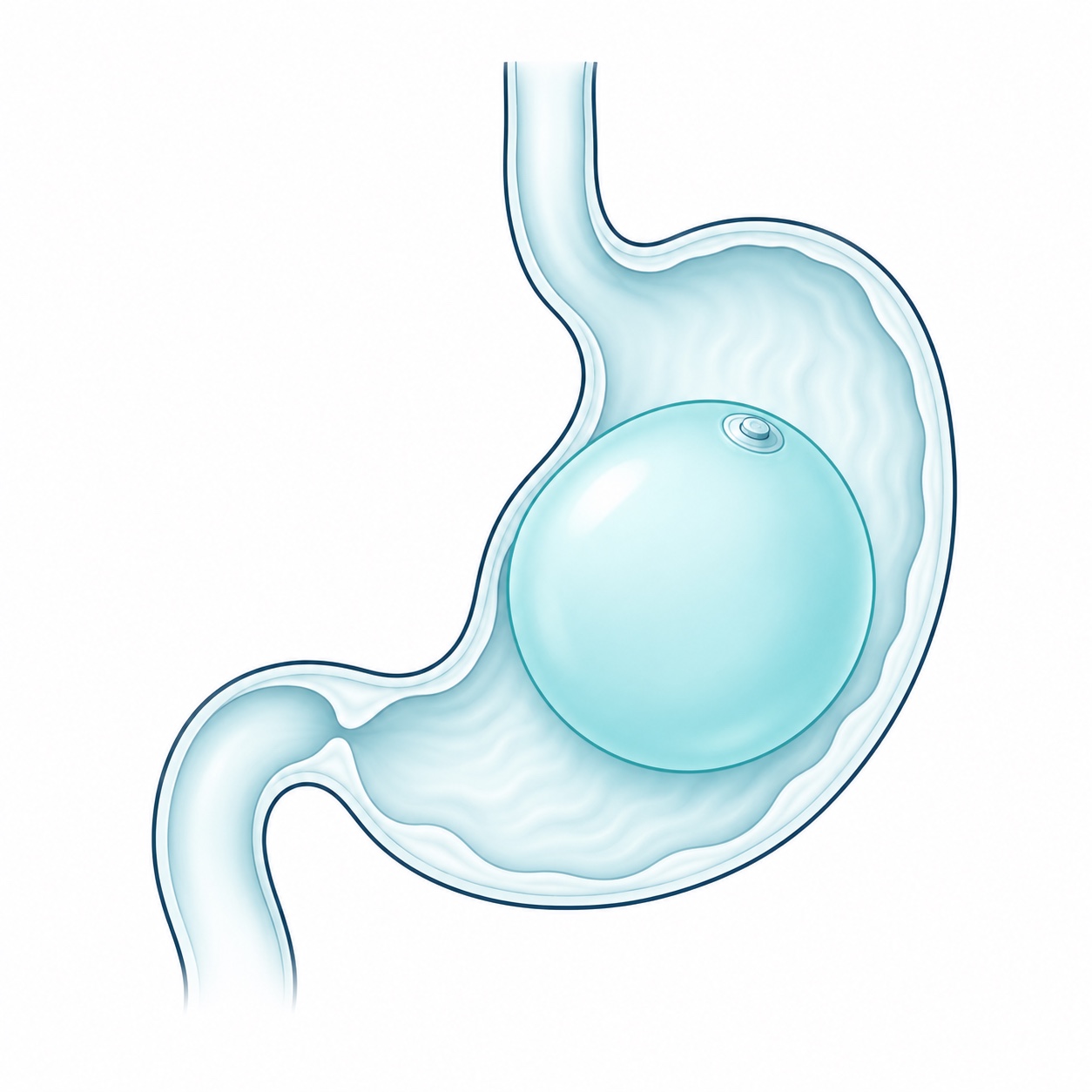 Esquema ilustrativo de Balón intragástrico