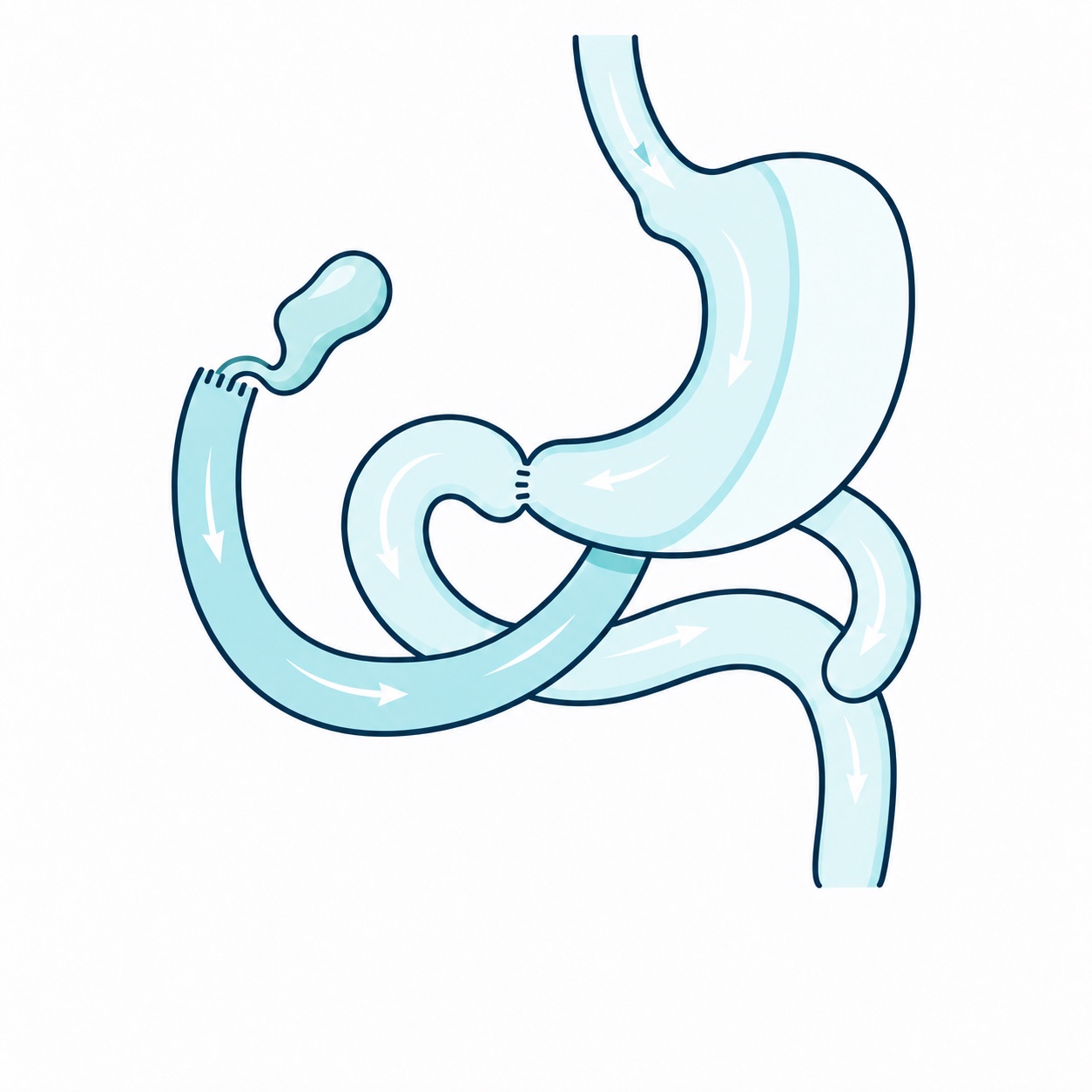Esquema ilustrativo de cruce duodenal o duodenal switch