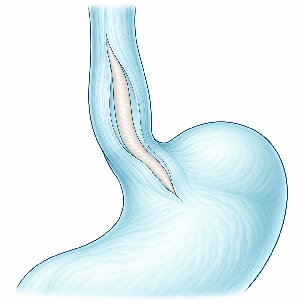 Esquema ilustrativo de cardiomiotomía de Heller