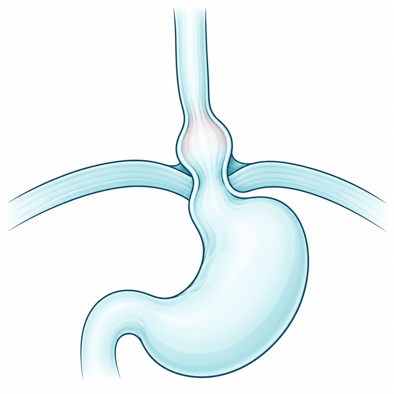 Esquema ilustrativo de hernia hiatal