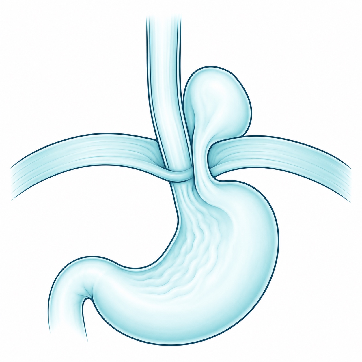 Esquema ilustrativo de hernia paraesofágica