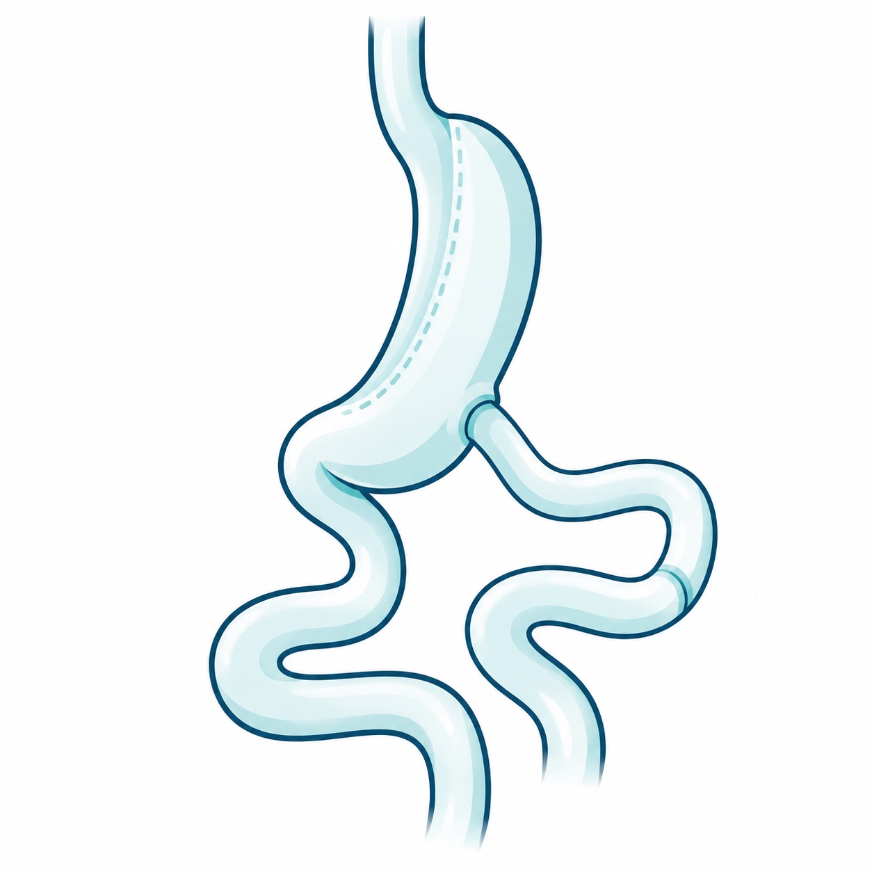 Esquema ilustrativo de SASI o bipartición intestinal