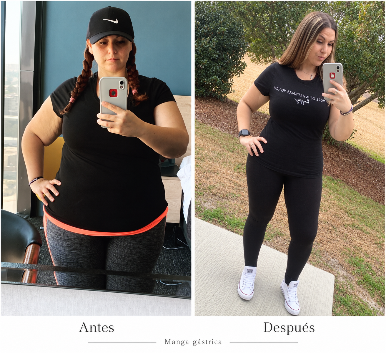 Manga gástrica · Antes y después